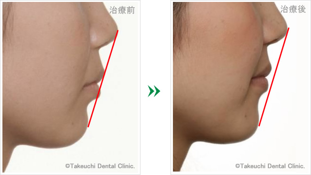 口元のラインの改善例