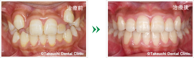 がたがたの歯並びの改善例