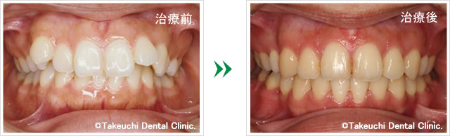 デコボコの歯並びの改善例